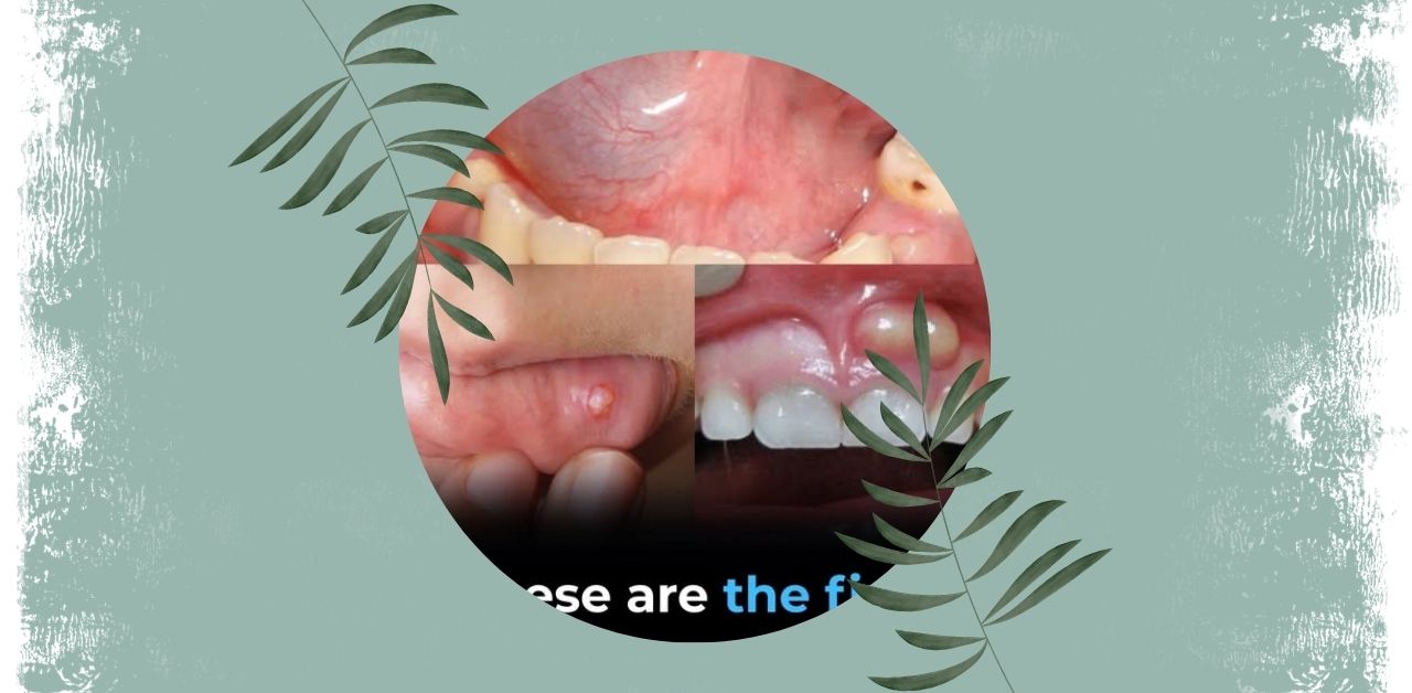 Early Symptoms of Oral Health Conditions