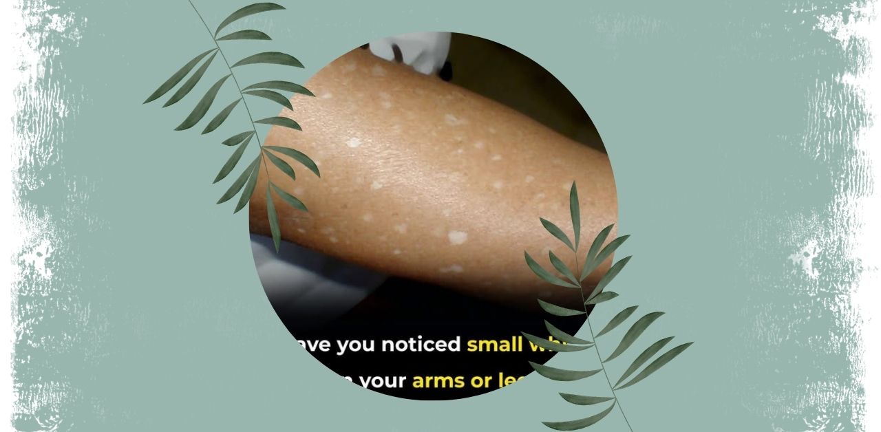 Small White Spots on Skin Causes, Care, and When to Seek Help