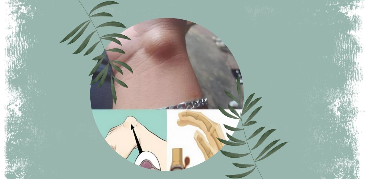 Ganglion Cysts A Common Wrist Lump