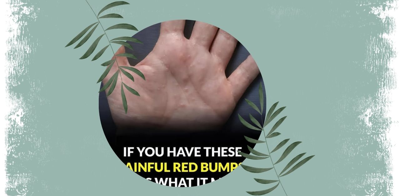 Painful Red Bumps on the Palm You Need To Know
