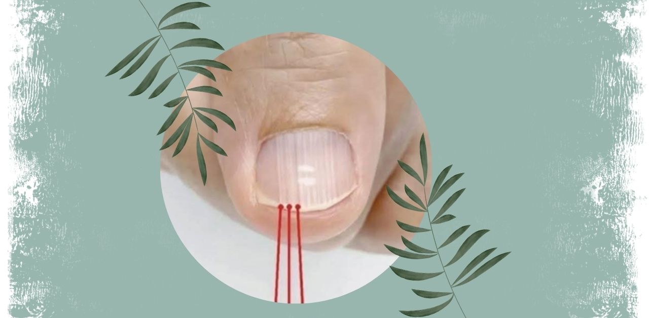 Unusual Nail Changes Threads or Lines Emerging from the Nail