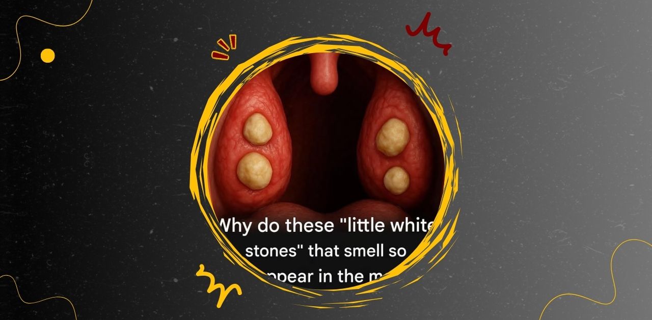 Why Do Little White Stones That Smell Bad Appear in the Mouth?